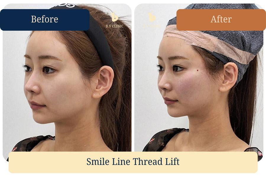 Before and After Nasolabial Thread Lifting