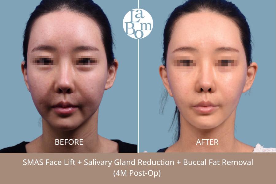 LABOM Plastic Surgery before and after image