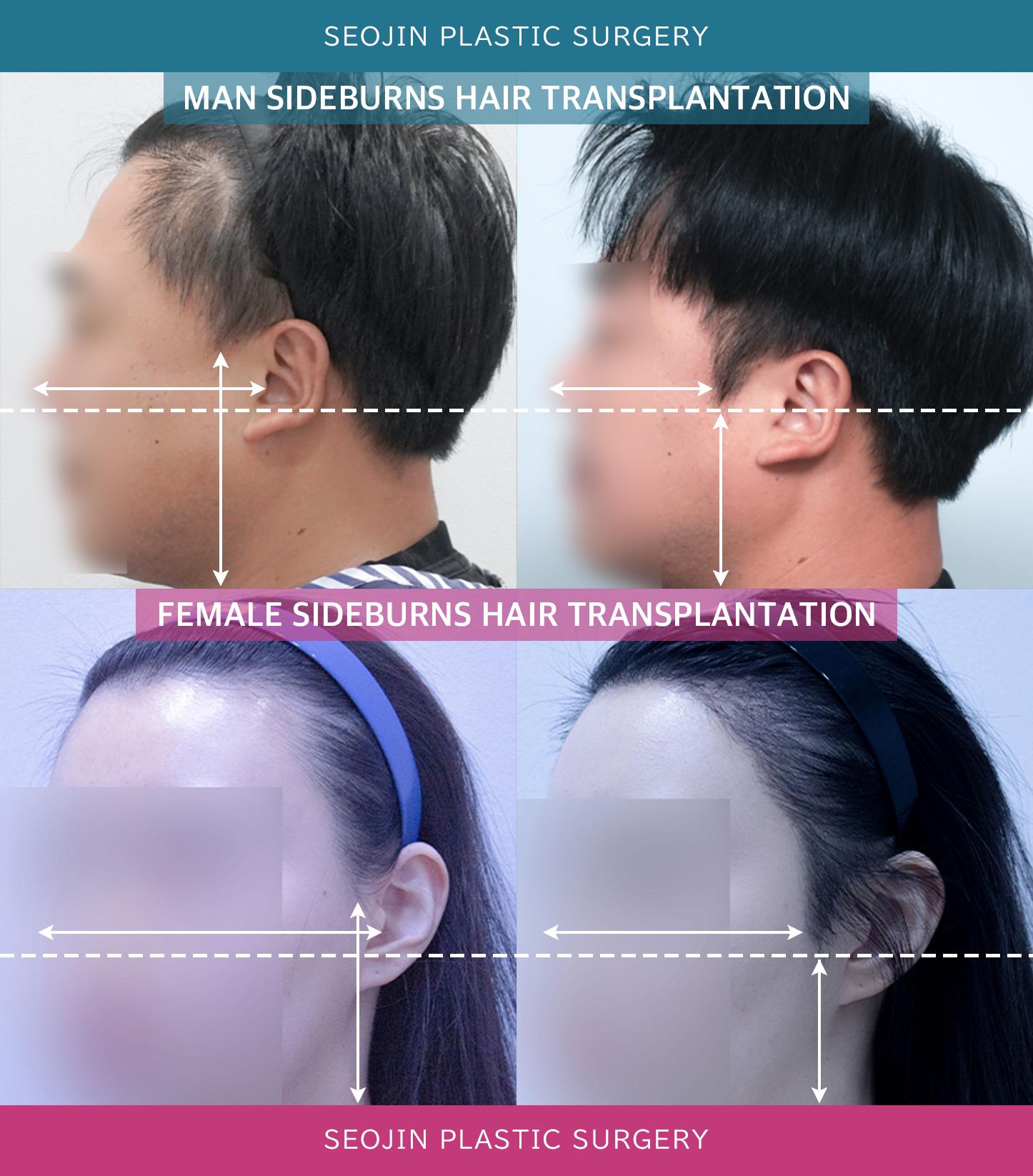 Vorher-Nachher-Bild der Seojin Plastic Surgery Clinic