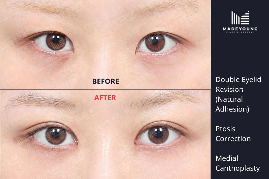 Eyelid revision natural adhesion ptosis correction medial canthoplasty