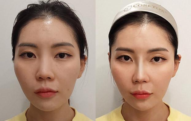 Female nose thread lift