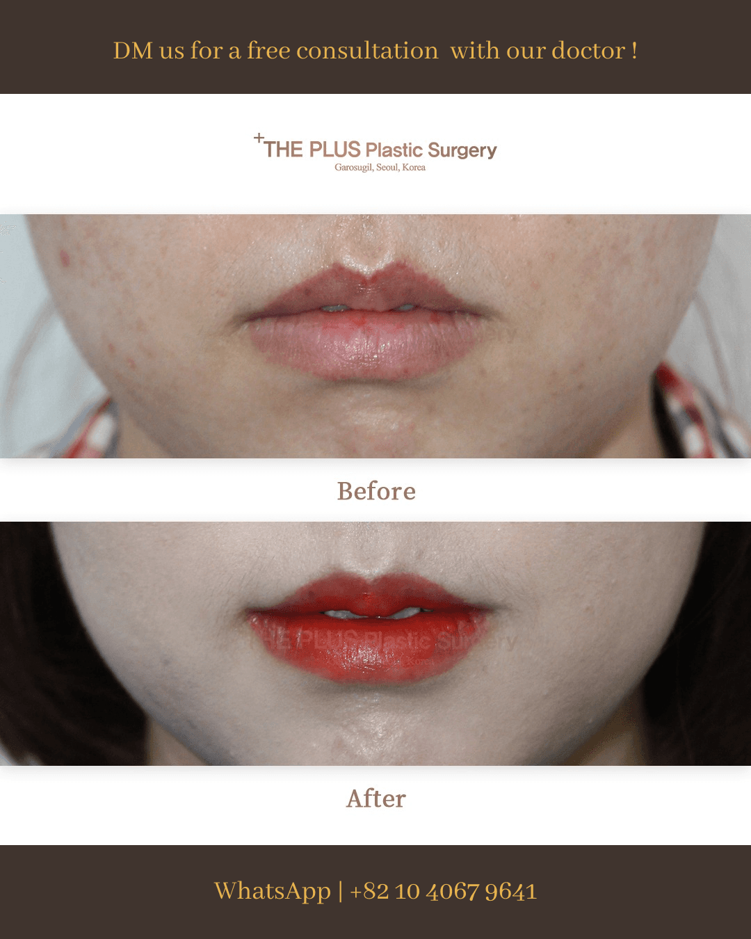 Mundwinkel-Lift mit Botox
