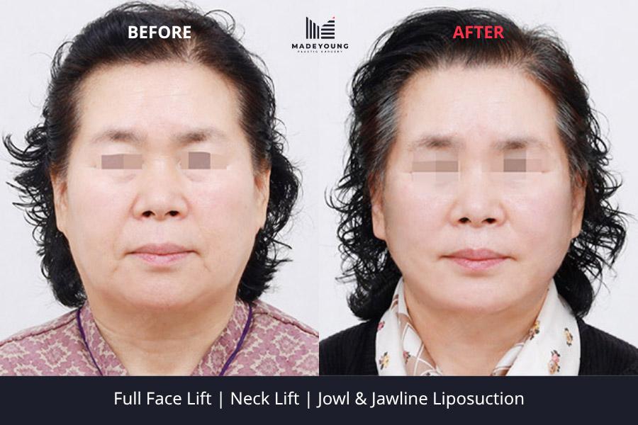 Face lift neck lift jowl jawline liposuction