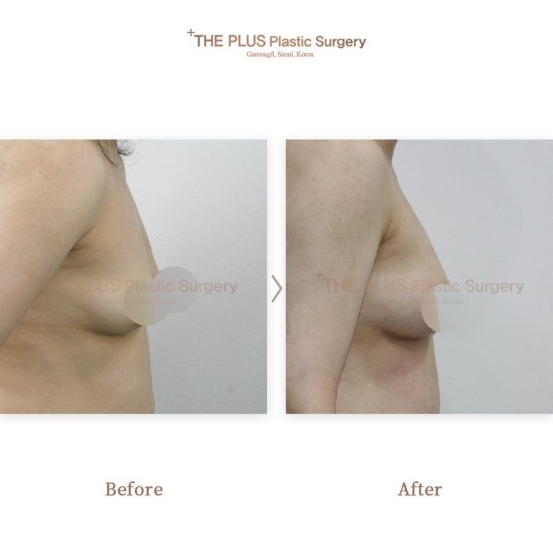Breast augmentation with autologous fat grafting