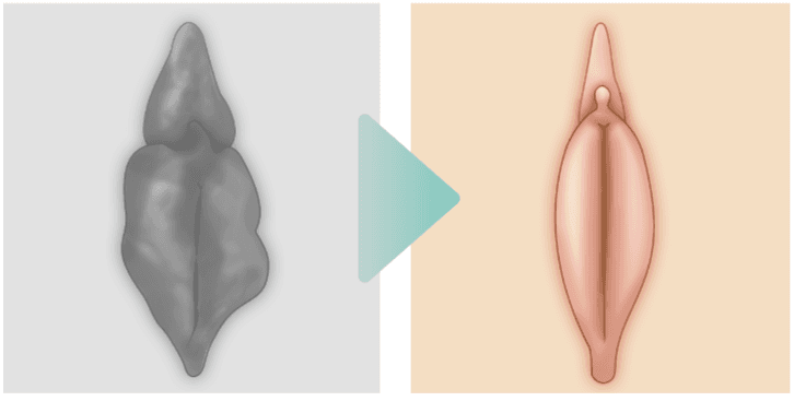 Petit-Vaginalplastik