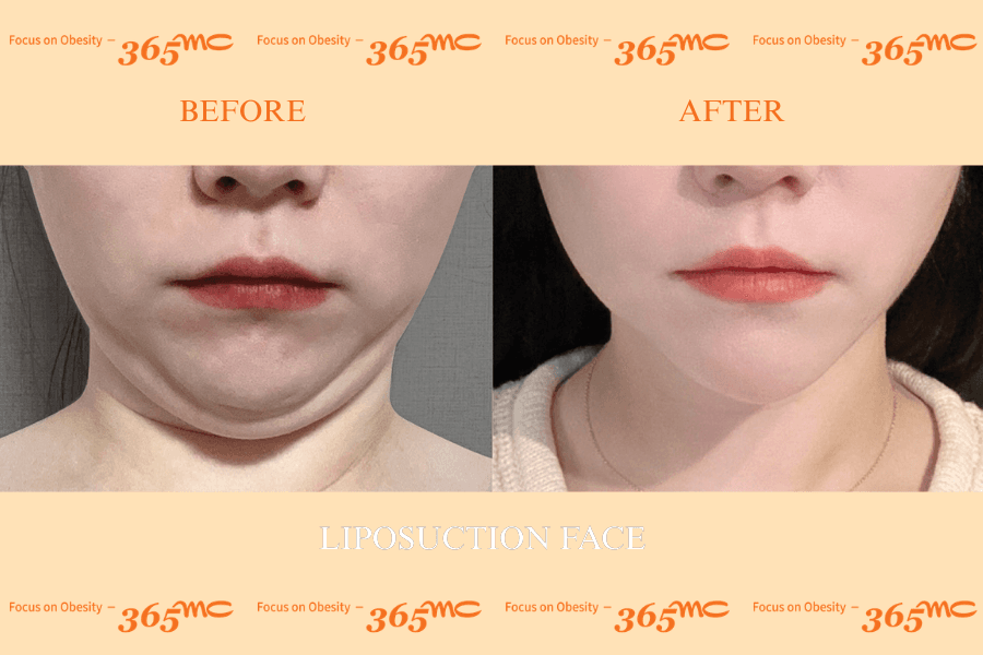 Liposuction - face