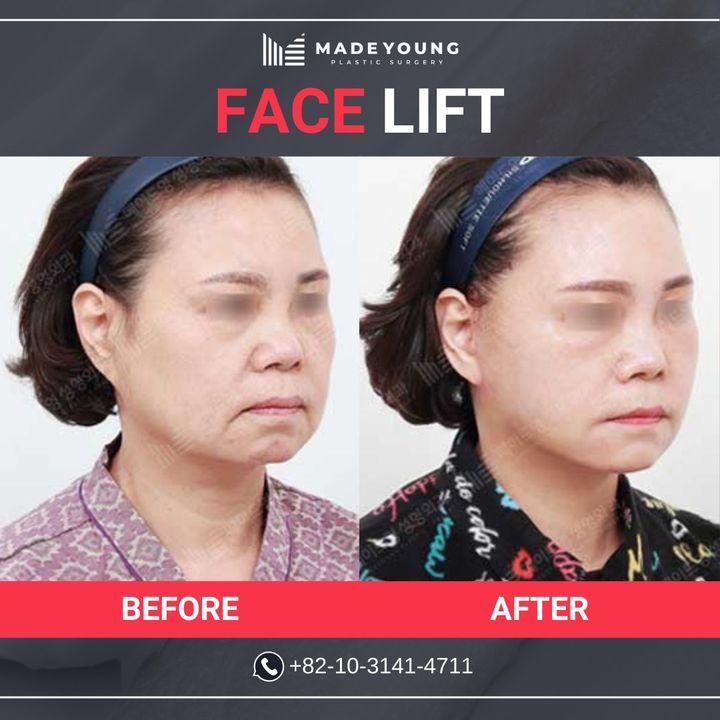 Turn back the clock with our advanced facelift techniques. Witness the rejuvenating effects in our before and after gallery.