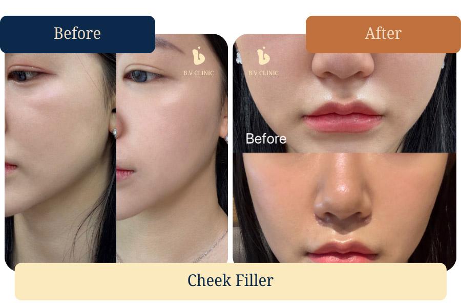 인디언주름(midface groove) filler injection