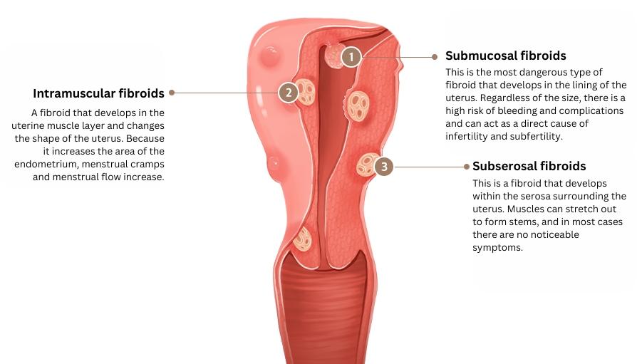 Uterine Fibroids Treatment