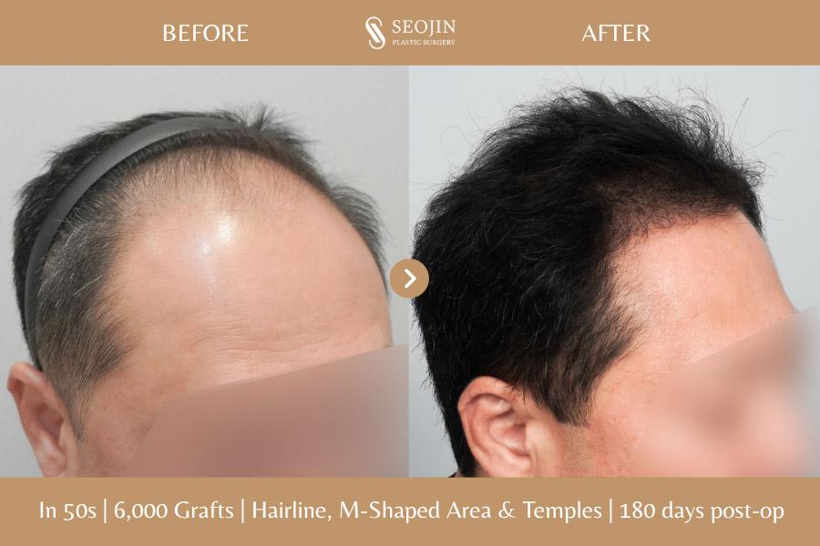 Seojin Plastic Surgery Clinic before and after image