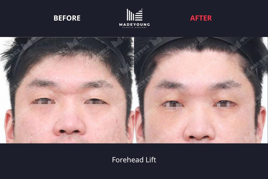 Made Young Plastic Surgery before and after image