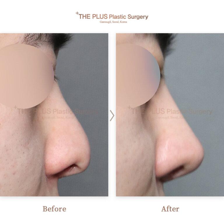 Vorher-Nachher-Bild von THEPLUS Plastic Surgery