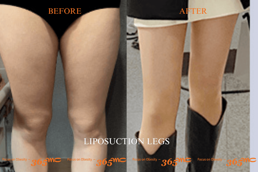 Liposuction- legs