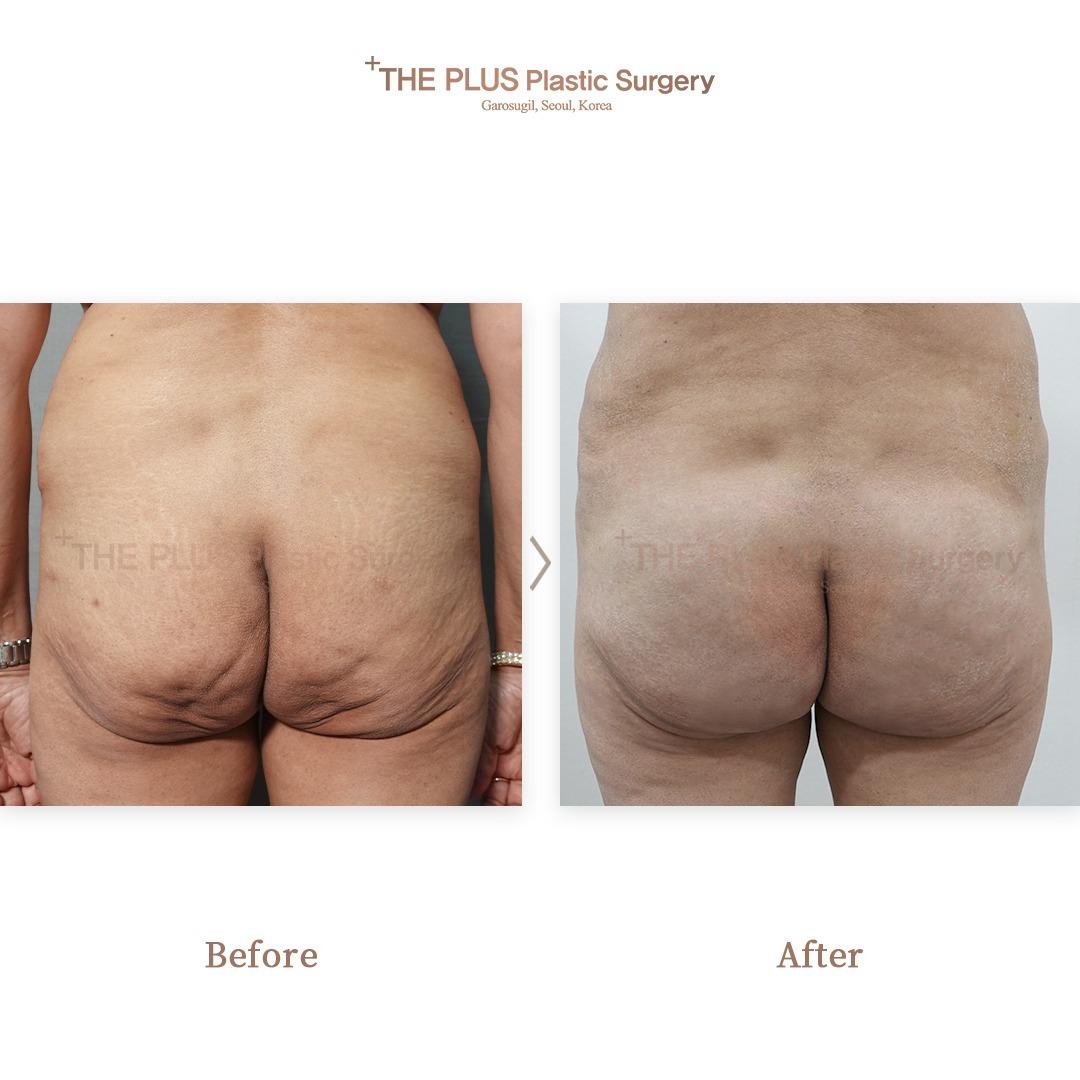 THEPLUS Plastic Surgery before and after image