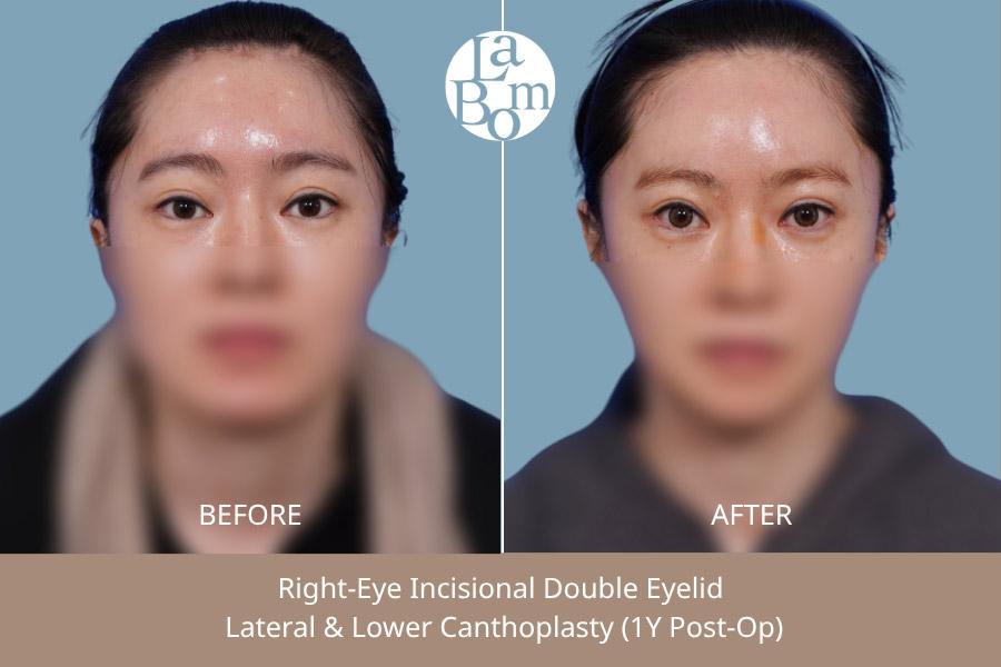 Before and After Endotine Lift