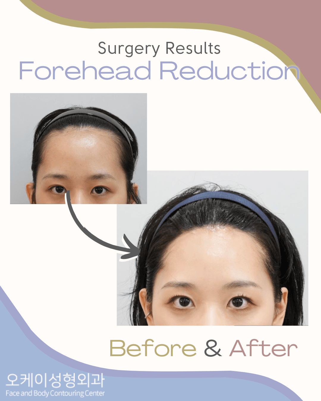 Forehead Reduction