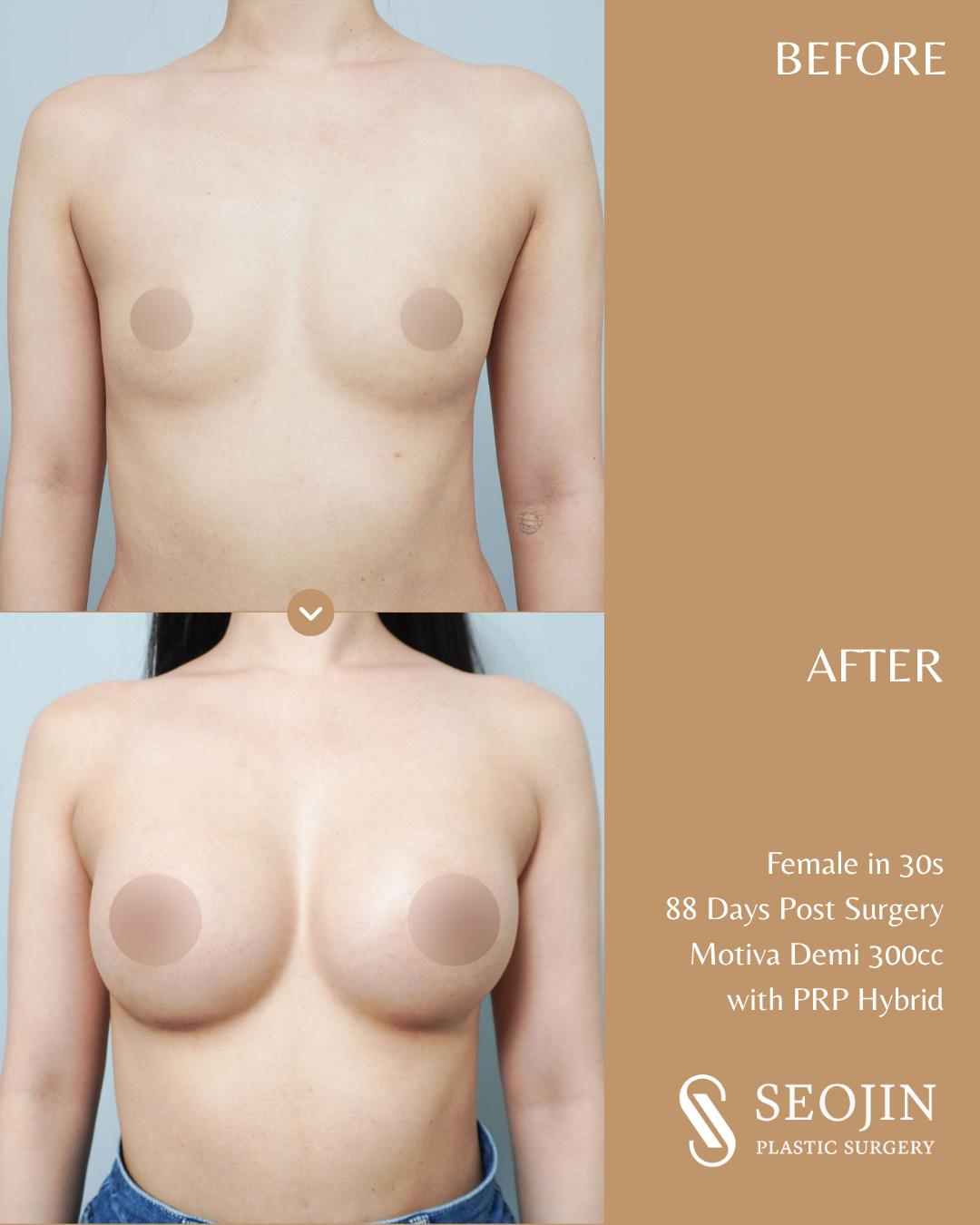 seojin-breast-implant-3