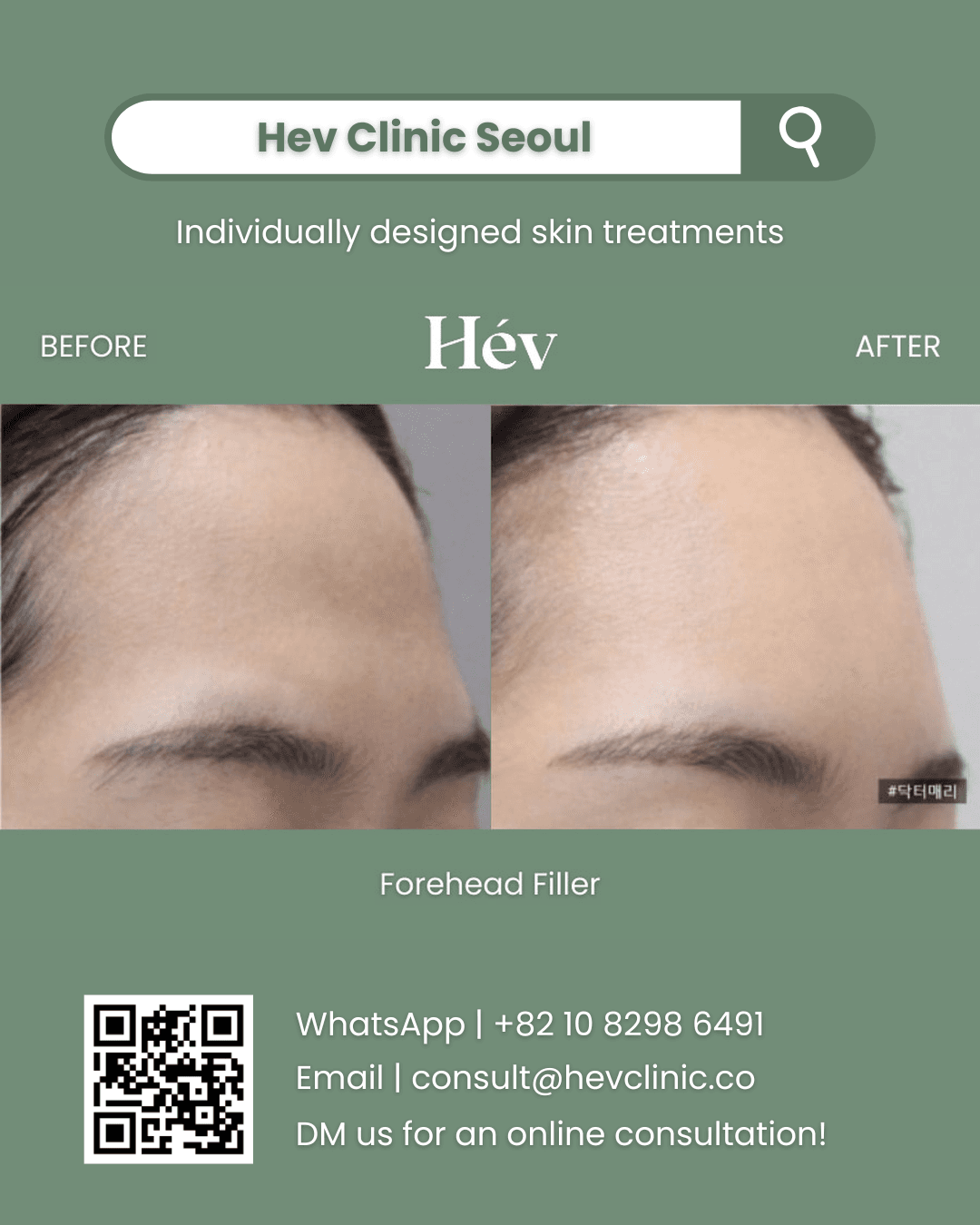 Forehead Filler