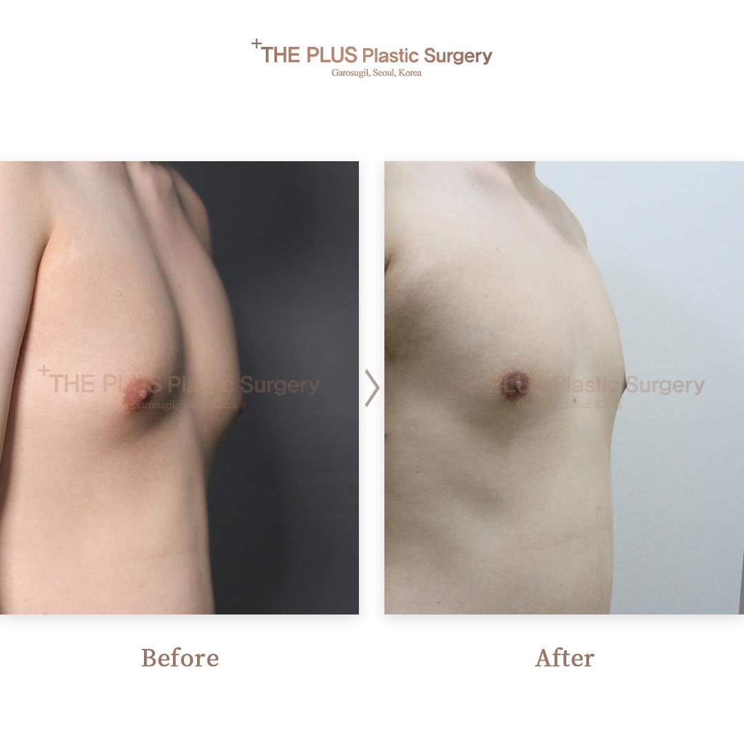 THEPLUS Plastic Surgery before and after image