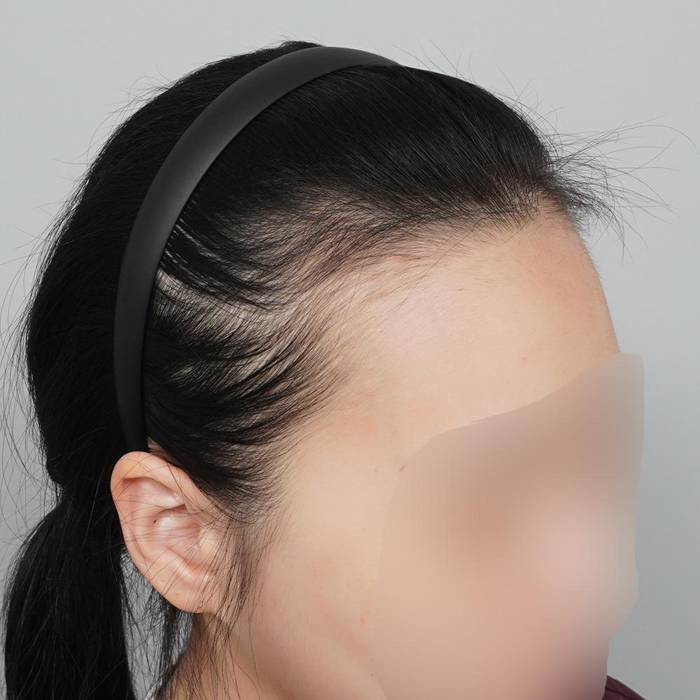 Hair Transplant • Additional Treatment: PRP Hair Loss Treatment • After: 372 days post-op • Details: 3,000 grafts (hairline, M-shape, temples) + PRP
