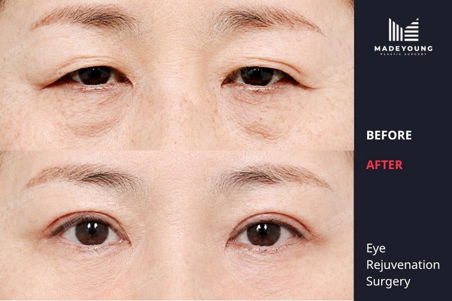 Made Young Plastic Surgery before and after image