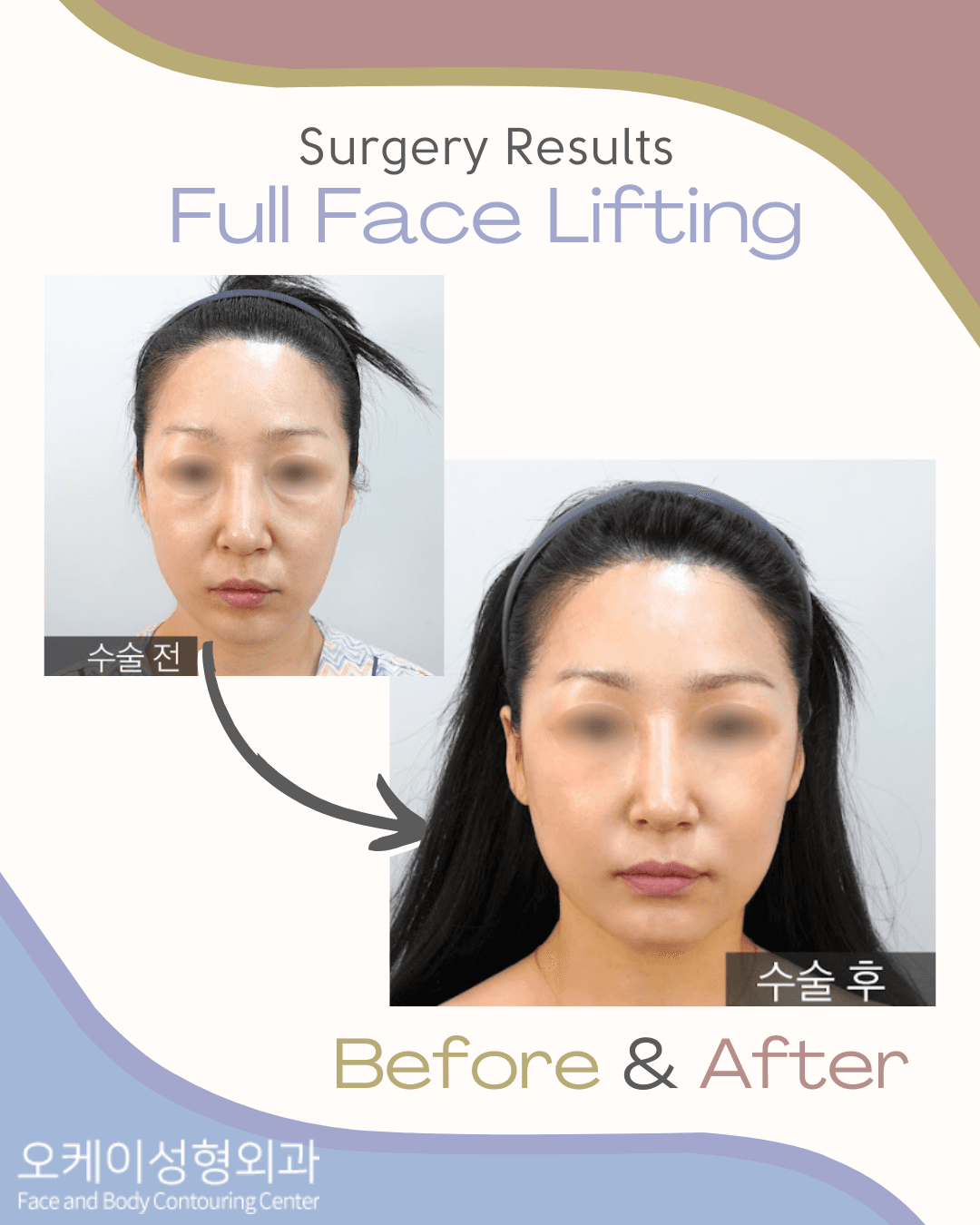 Vorher-Nachher-Bild der Okay Plastic Surgery Clinic