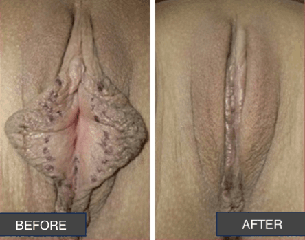 Okay Plastic Surgery Clinic before and after image