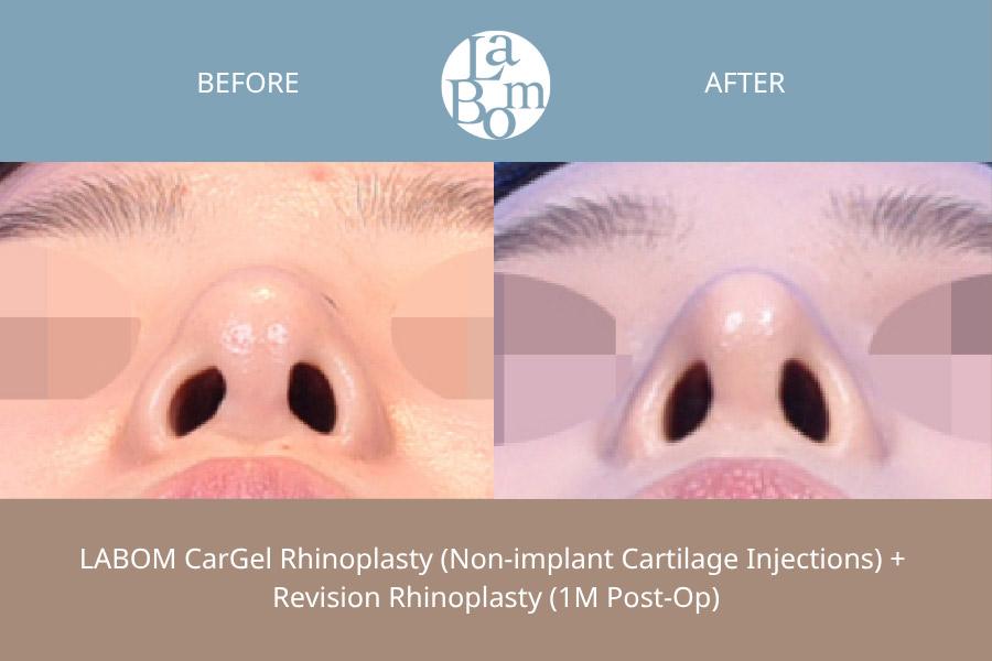 Before and After Non-Surgical Rhinoplasty