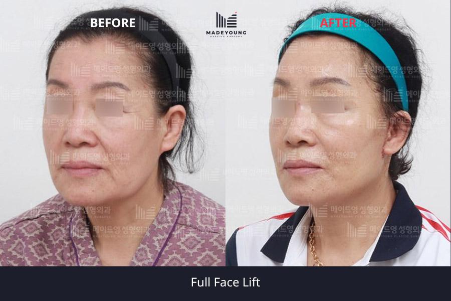 Made Young Plastic Surgery before and after image