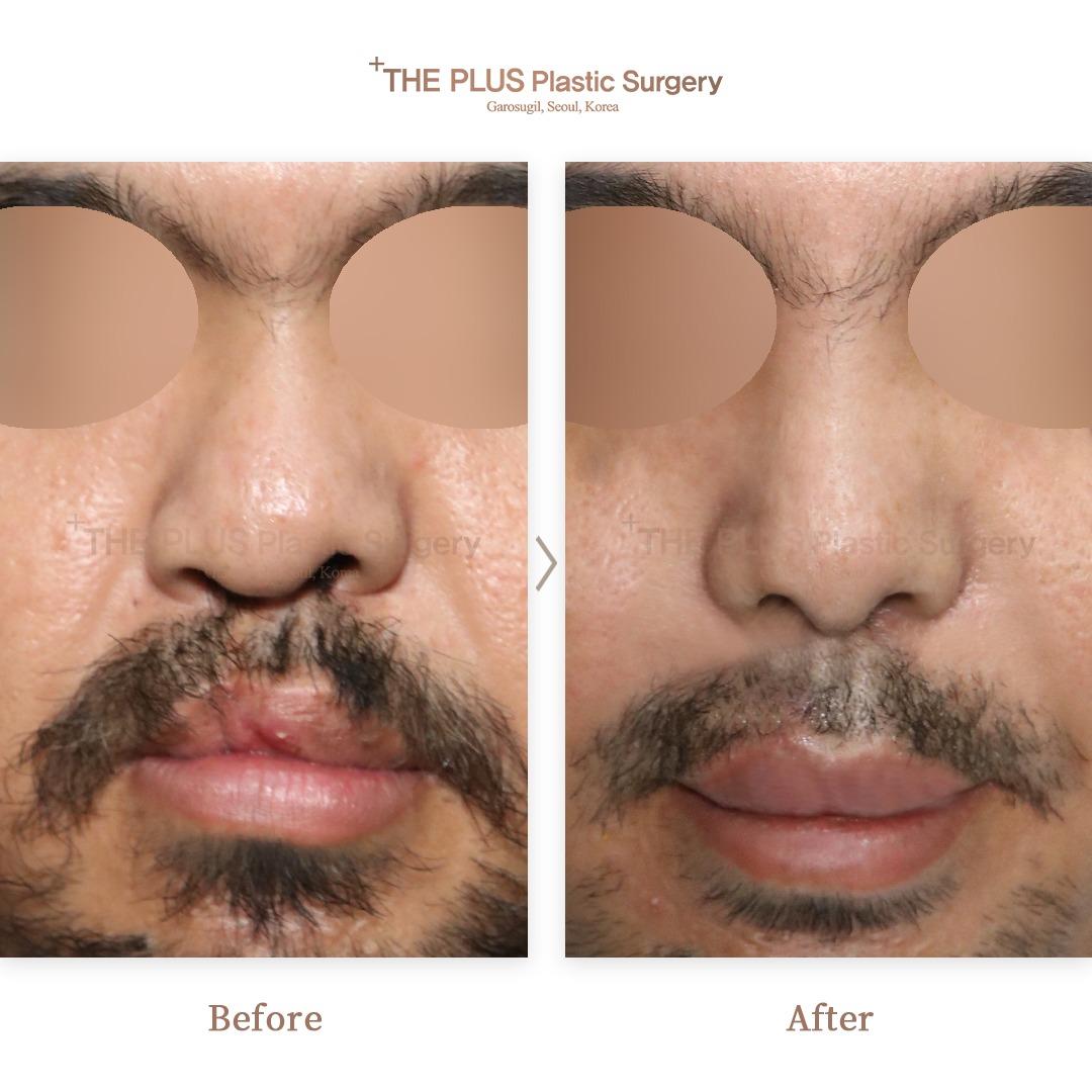 THEPLUS Plastic Surgery before and after image