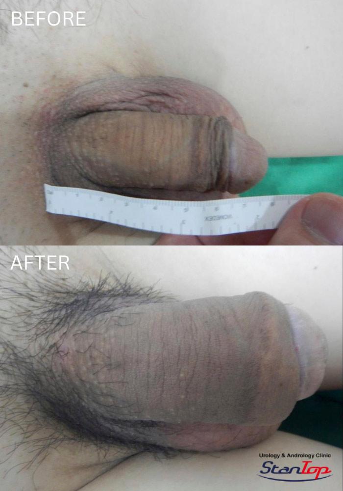 Penis Enlargement
