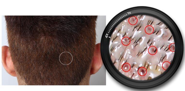 Hair Transplant