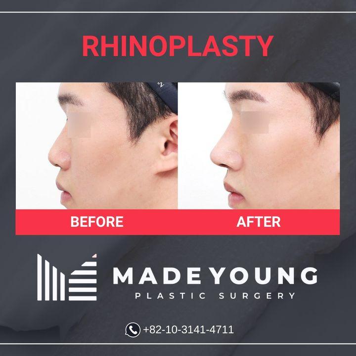 Redefine your profile with our Rhinoplasty procedure. The before and after pictures showcase the art of nose reshaping, enhancing facial harmony while respecting your natural features. Begin your journey to a more confident you. #Rhinoplasty #nosereshaping