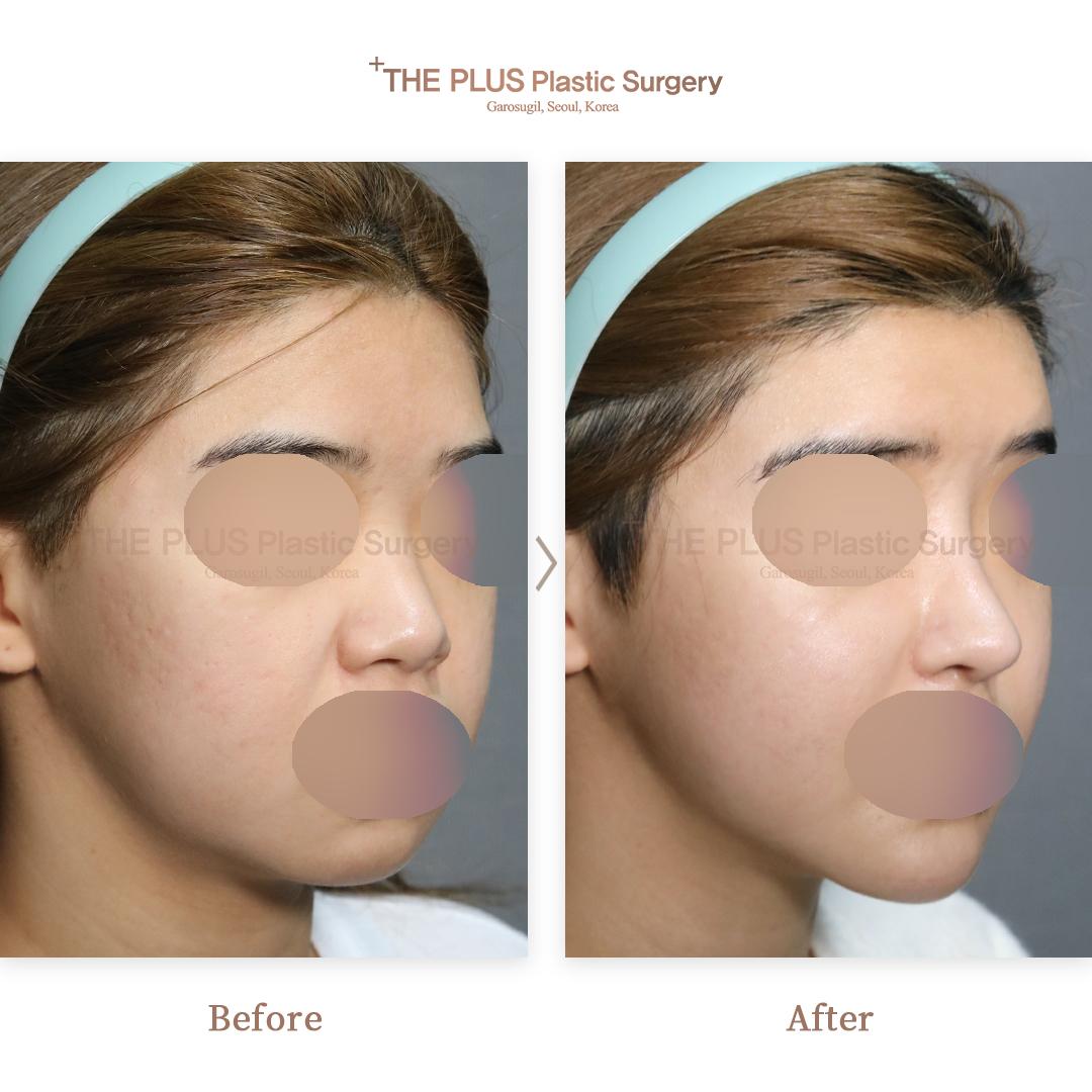 Chin Implant & Face Fat Grafting