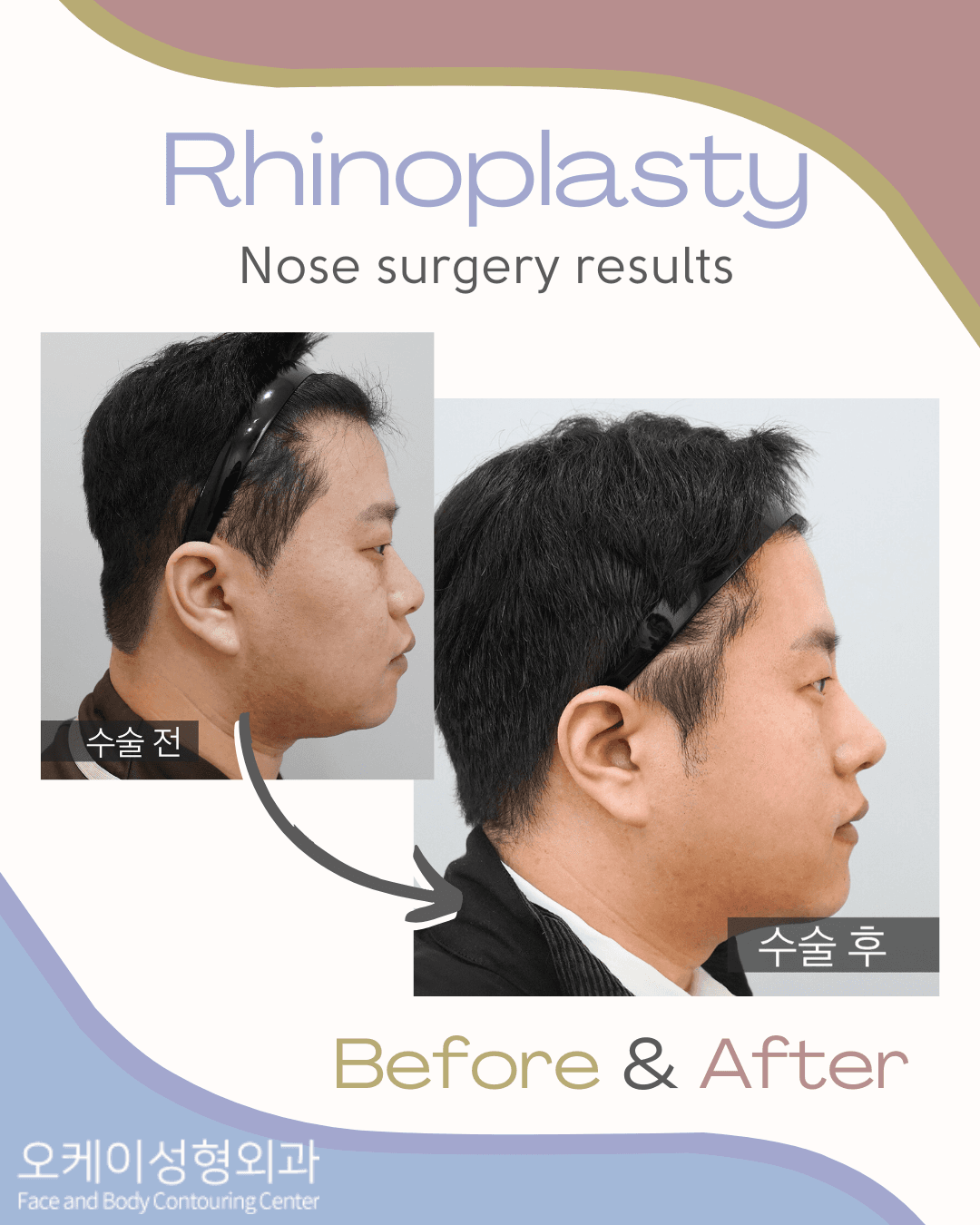 Vorher-Nachher-Bild der Okay Plastic Surgery Clinic