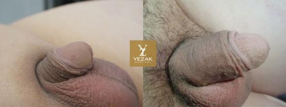 Before and After Penis Enlargement
