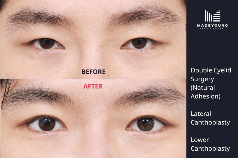 Eyelid surgery natural adhesion lateral canthoplasty lower canthoplasty