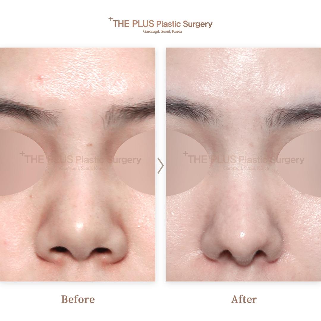 THEPLUS Plastic Surgery before and after image
