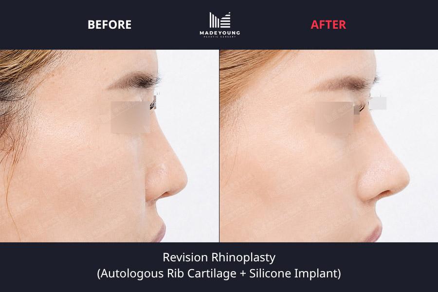 Rhinoplasty autologous rib cartilage silicone implant