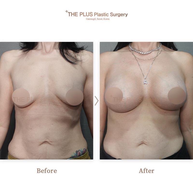 Breast Lifting + Breast Implants