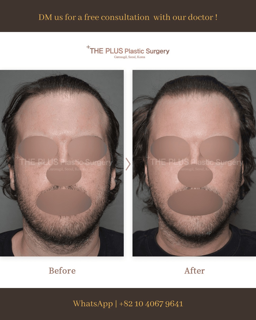 Double Chin Tightening, Quick Lift, Chin Surgery