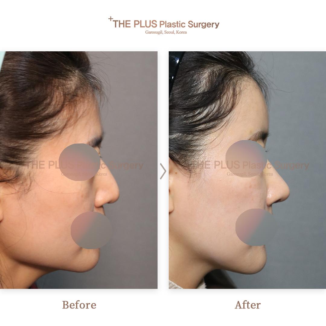 Full Face Contouring