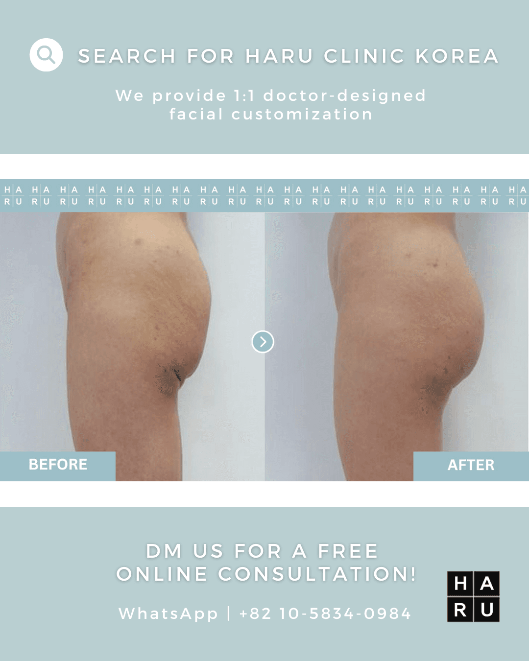 Butt Thread Lift