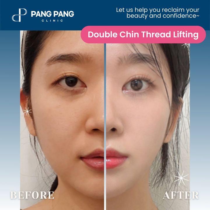 Transform your future with our Thread Lift magic! Check out these stunning before-and-after photos showcasing the incredible results our clients have achieved. Witness the power of threads as they sculpt, lift, and revitalize. Are you ready to be the next success story? 💫✨ #ThreadLiftTransformation #BeforeAndAfterMagic #RealResults