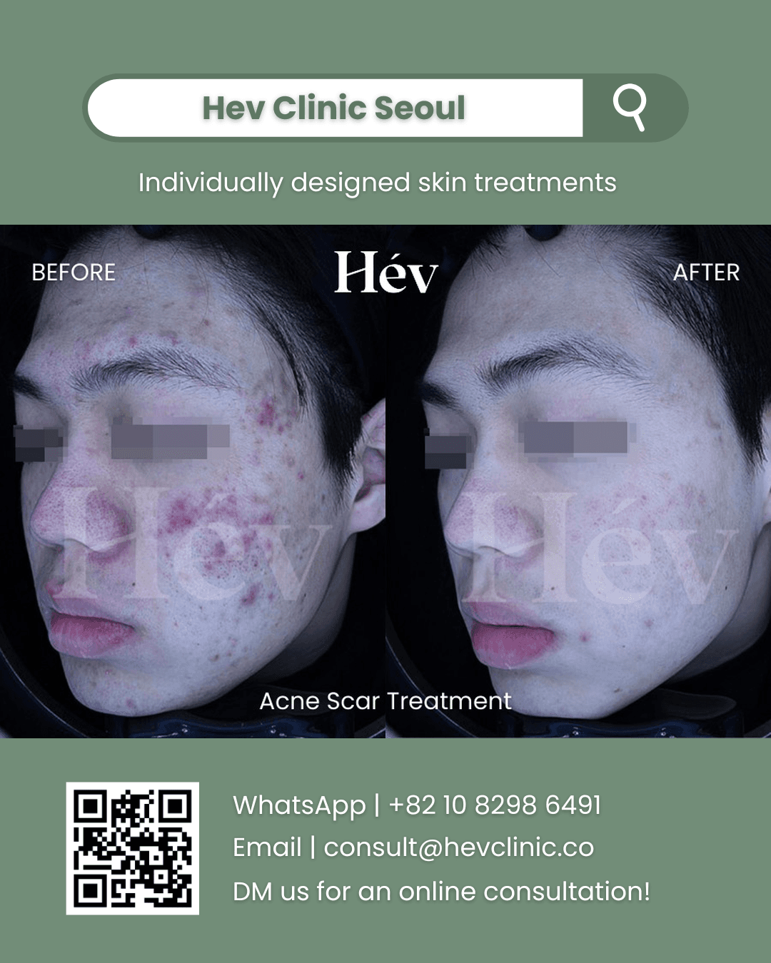 Acne Scar Treatment, Acne Treatment