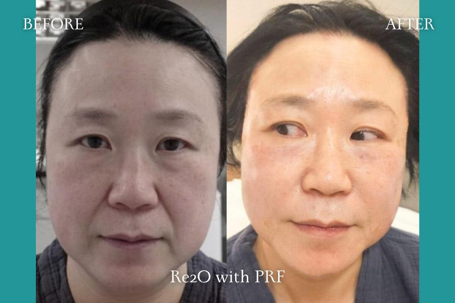 Re2O with PRF
