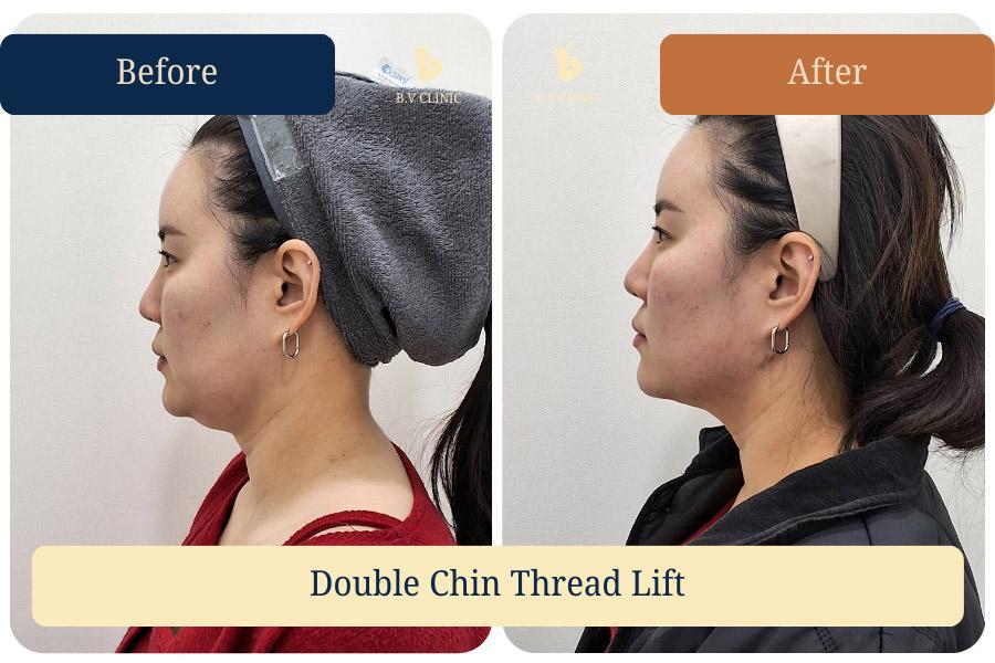 Double Chin Thread Lifting Using Double-Arm Threads