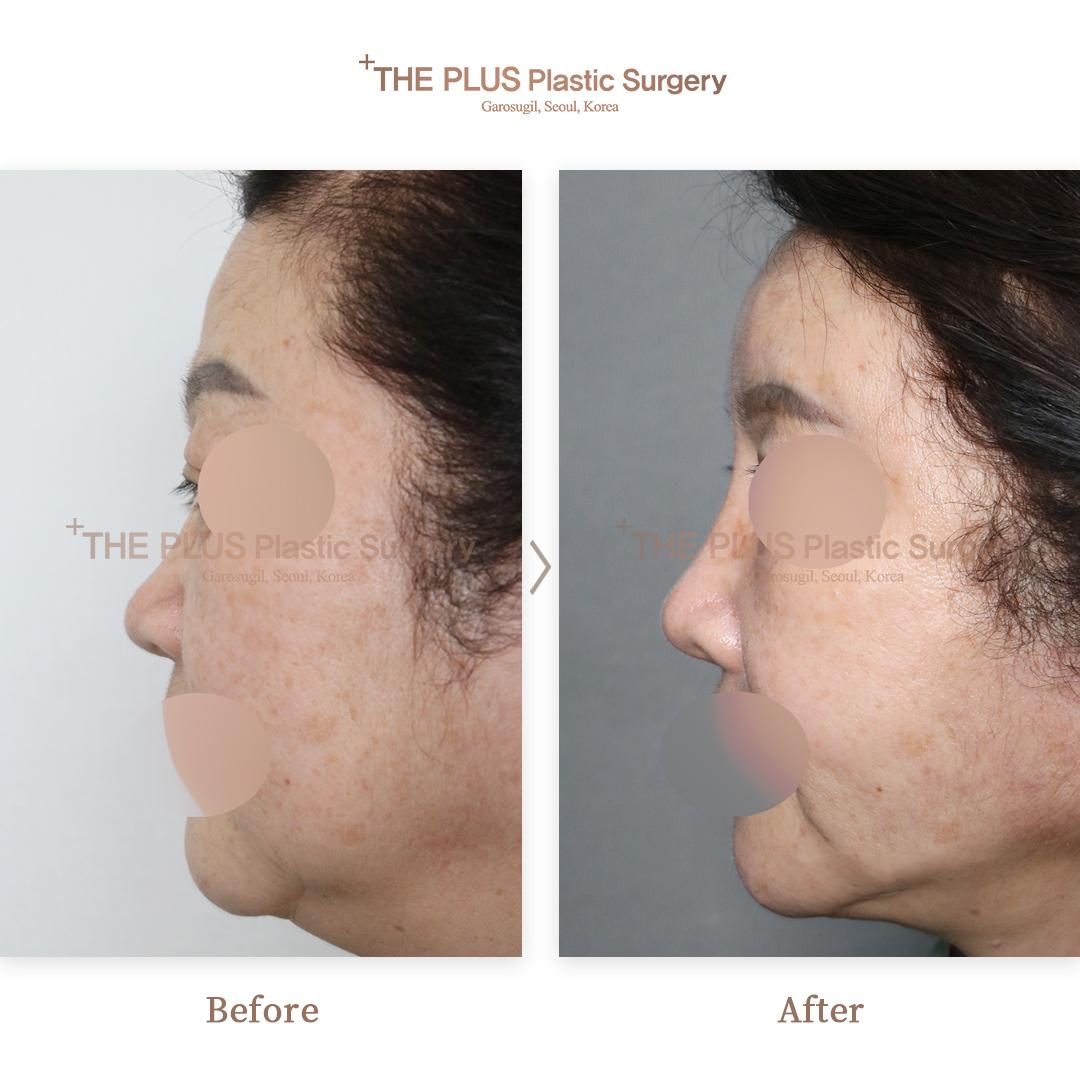 Facelift & Face Fat Grafting