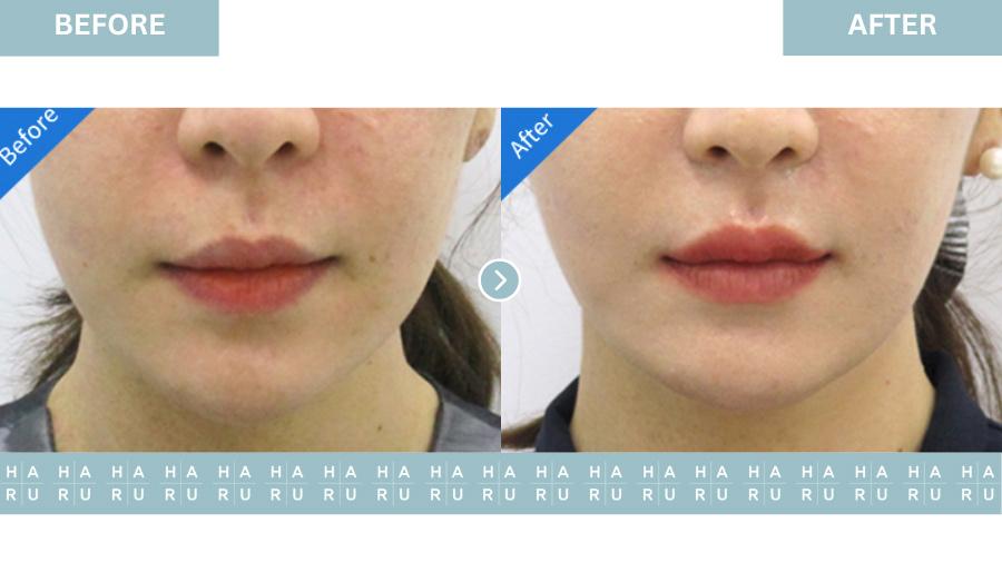 Lip Thread Lift, Bullhorn-Lip-Lift