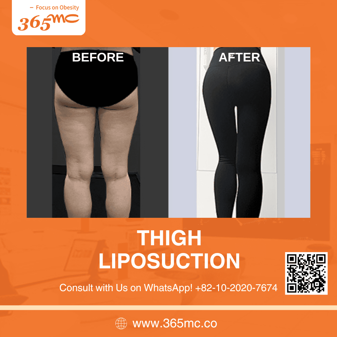bna-thigh-iiposuction.png